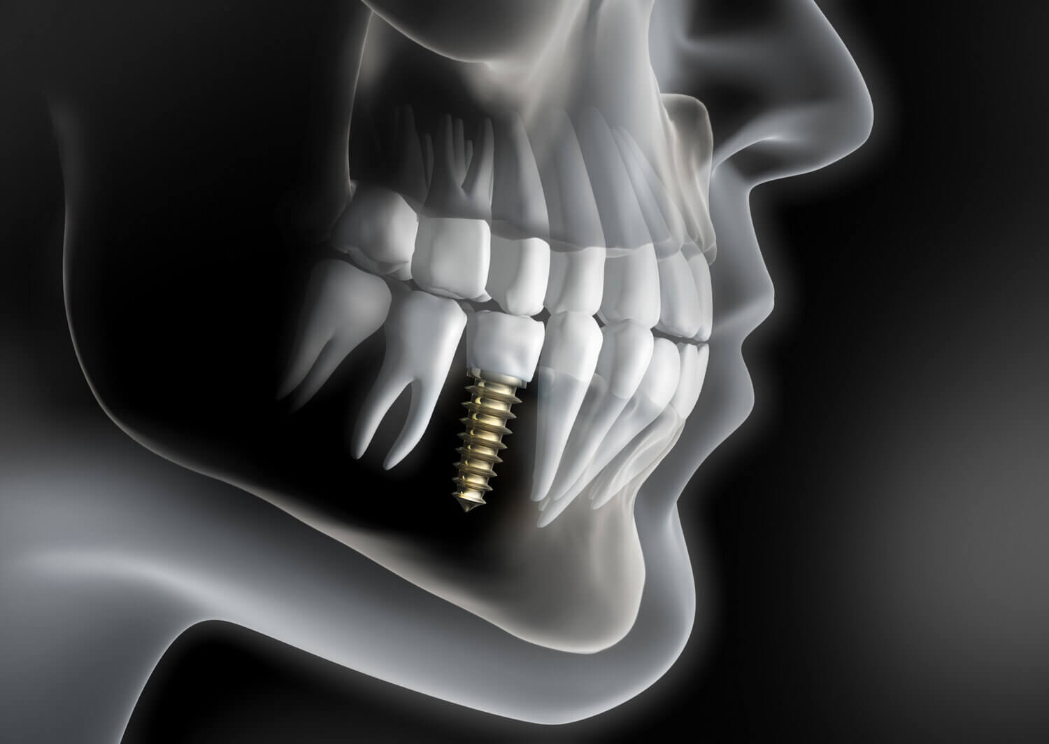 Are Implants Safe The Benefits And Risks Of Dental Implants Twilight Dental Group 