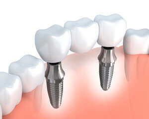 Teeth in a Day - Dentist Edmonton - Twilight Dental Group Teeth in a Day - Dentist Edmonton - Twilight Dental Group